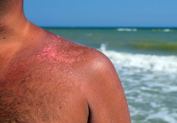 How to Prevent Beach Chafing